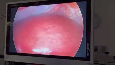 Video of mini gastric bypass