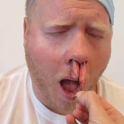 Nasal packing being removed after sinus surgery!