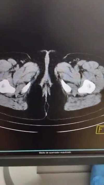 This is the first time I see that many cysts.... Pt only referred mild back pain