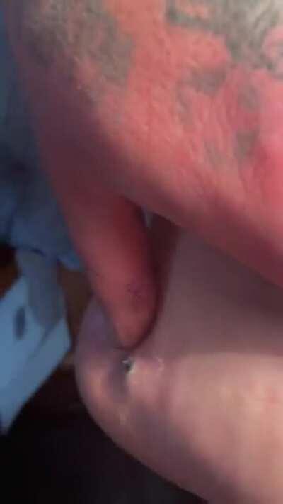 Removing a BB stuck in a foot with a magnet