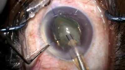 This is the cataract surgery in MrBeast's video. It's the most common cause of reversible blindness in the world