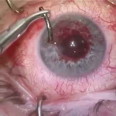 Fish hook removed from eye!