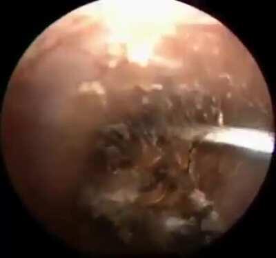 Doctor finds bugs living in a man's ear