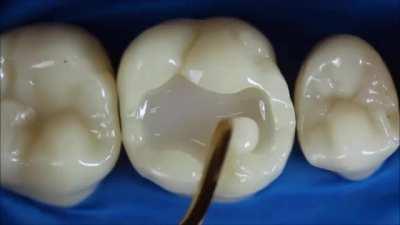 A huge hole in a tooth can be repaired with dental composite resins in a seamless manner.