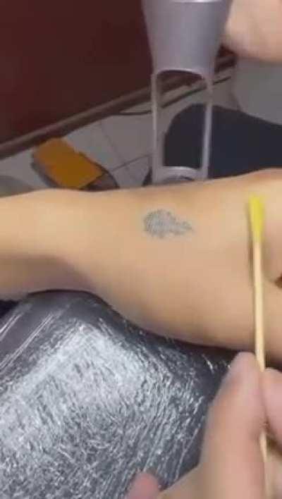 Tattoo removal with laser