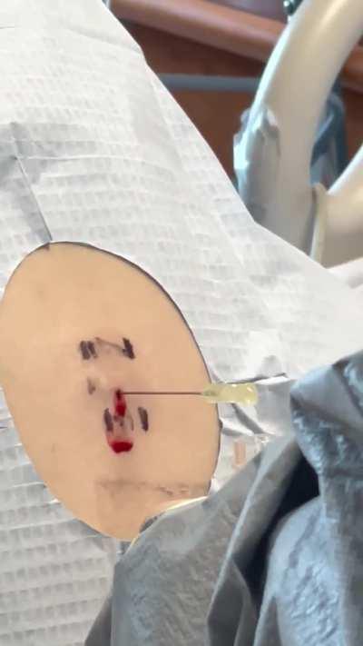 Cerebrospinal fluid collection during lumbar puncture (collected to test for CNS lymphoblastic leukemia spread)