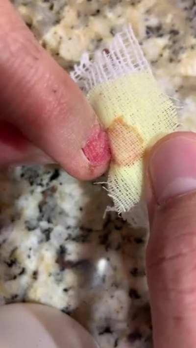 Here’s a follow up to my fingernail removal. This hurt way worse and was like that for a good week! Original in comments!