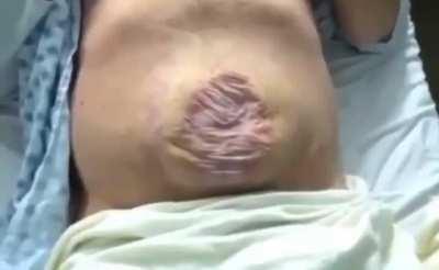 GIANT Abdominal Hernia