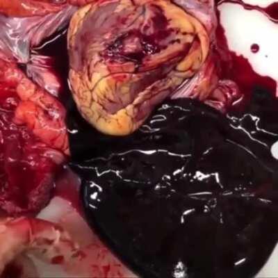 Heart-attack with cardiac perforation and tamponade (autopsy)