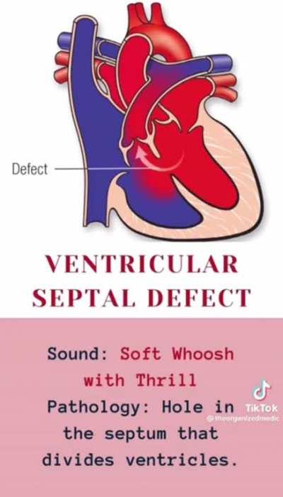 How different heart beats sound through a stethoscope