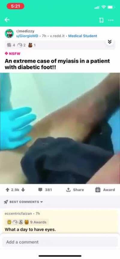 Absolutely disgusting video of an extreme case of myiasis in a patient with diabetic foot.. credit to u/GiorgioMD