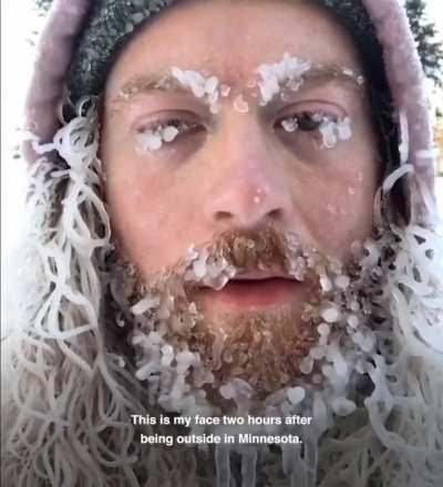 Timeline of man's face freezing in Minnesota.