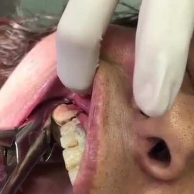 An extreme case of calculus tooth extraction.