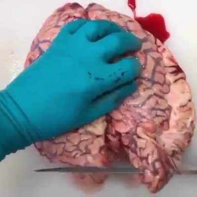 Intracerebral hemorrhage discovered during brain autopsy