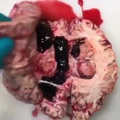 Intracerebral hemorrhage discovered during brain autopsy