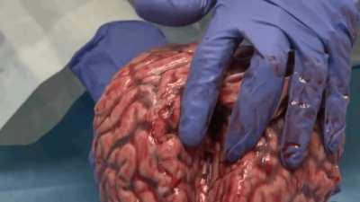 A 1400 gram brain fresh out from autopsy