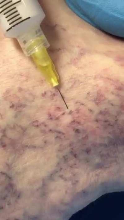 Procedure that is used to treat spider and varicose veins