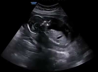 Ultrasound of a pregnant woman laughing 