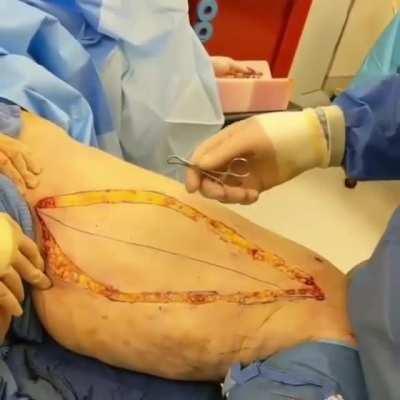 Intersting case of a thighplasty procedure!