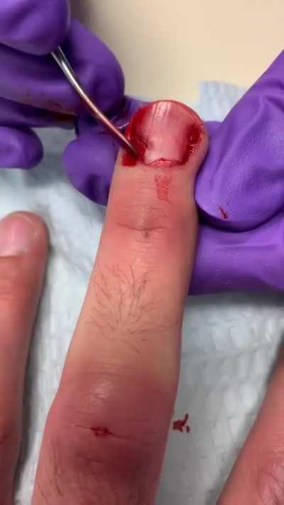 Had my fingernail removed after cracking the nail bed.