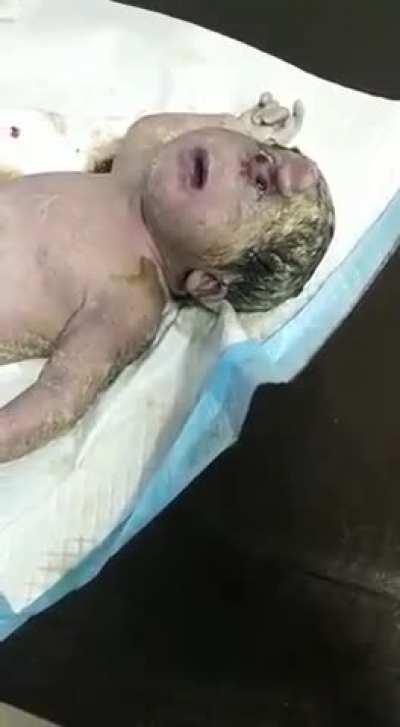 Newborn with Cyclopia with Proboscis, still responsive to environment