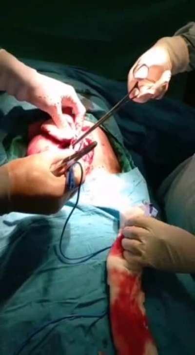 Removing a huge collection of hair (Trichobezoars) from the stomach of a 19yo female. (Rapunzel's syndrome)