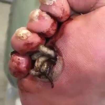 Maggots in feet . 😵