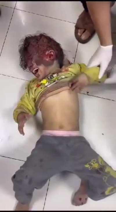Kids injured in after bombing their house