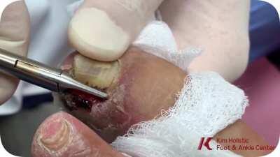 Nail growing deep into the skin removal