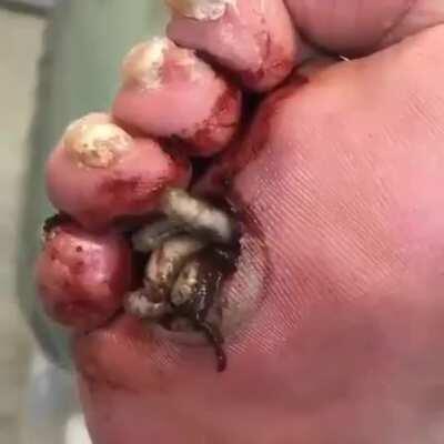 Maggots used in order to treat a diabetic’s foot