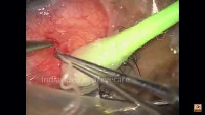 Removing a 20cm worm from a human eye