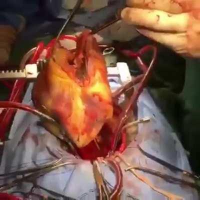 Heart transplantation in process! This doctor grasps and holds a diseased heart which had just been removed from a patient during a heart transplant operation.