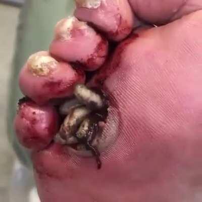 Therapeutic maggots on a diabetic foot!!