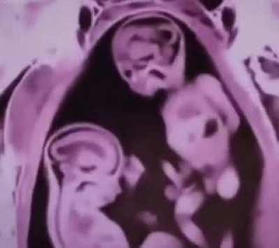 These twins in the mother were found fighting during a scan