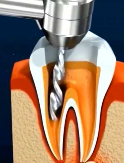 How root canal treatment works