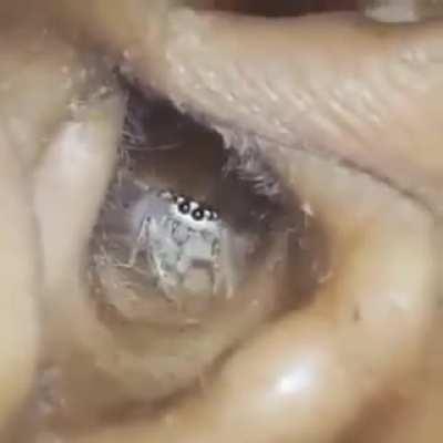 Man complains about constant itching & bizarre scratching sounds only to find this in his ear