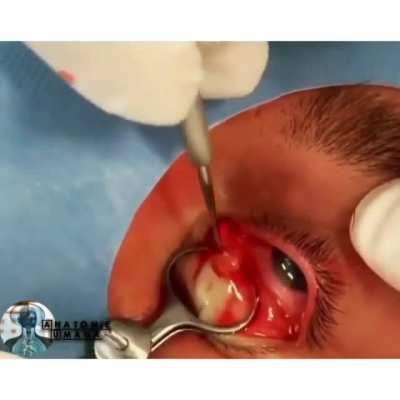 Removal of chalazion on the eyelid