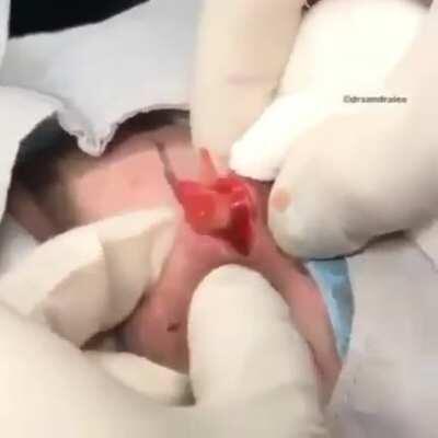 Head cyst!!