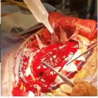 This is how a cerebral hemorrhage is removed