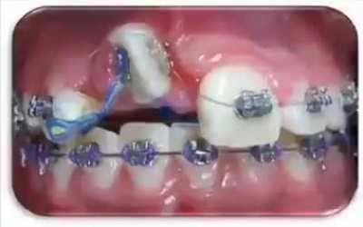 Watch braces in action, repairing unrepairable gnarly teeth.