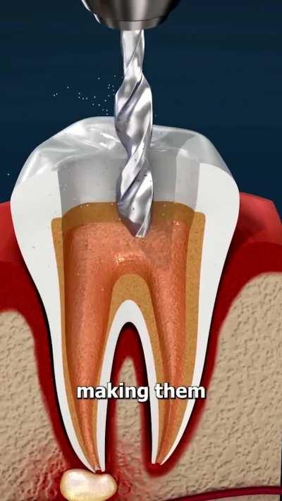 How Root canals work