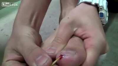 Guy kicks a wall with a toothpick in his toenail