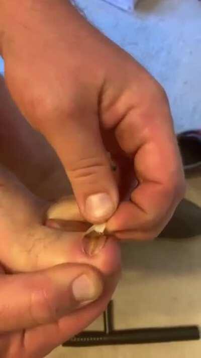 Homemade toenail removal