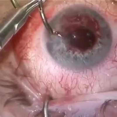 The video shows the extraction of a metal fish hook that got impaled in the patient's eye, piercing the cornea and damaging the iris.