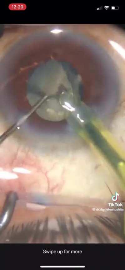 Cataract surgery