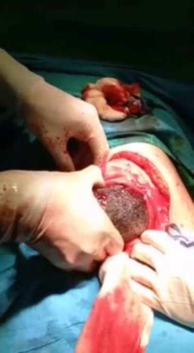 Trichophagia (Rapunzel Syndrome) removed from the stomach of a 19 year old girl.