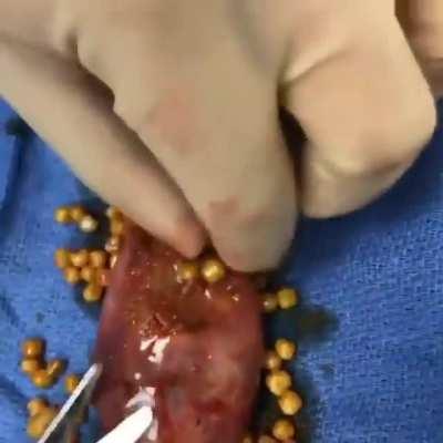 A gallbladder full of stones