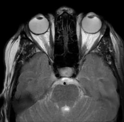 The Way The Optical Nerves Move With Eye Movement