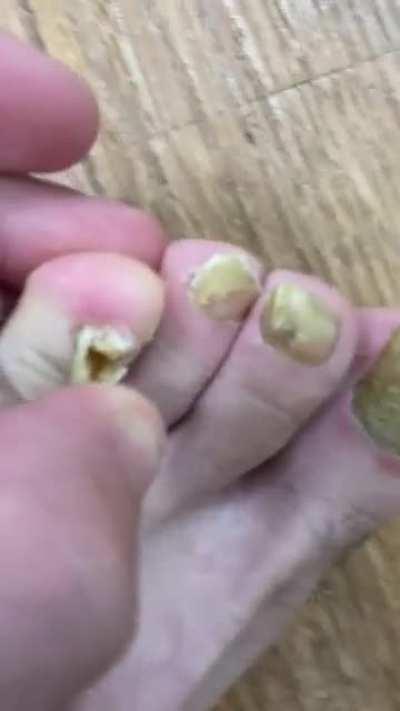 My loose, ingrown toenails🦶🤢