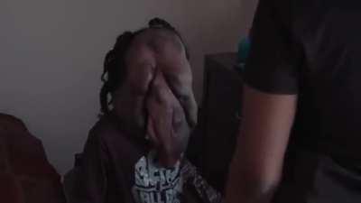 This boy was born with a rare condition called neurofibromatosis